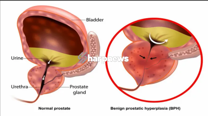 Screenshot-2024-10-12-at-06-44-48-Men-Over-40-Sure-Guaranteed-Remedy-To-Tackle-Prostrate-Cancer-And-Shrink-Prostrate-Enlargement-in-5-Days-operanewsapp